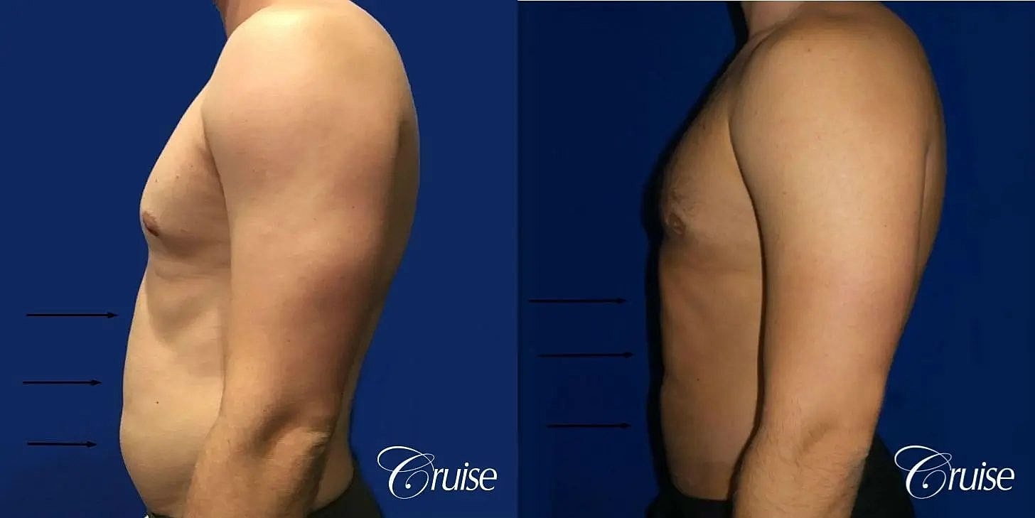 Liposuction Before & After