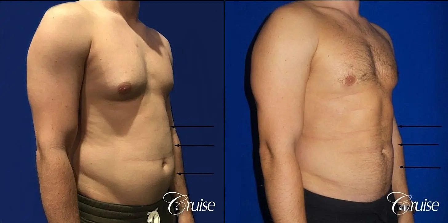 Liposuction Before & After