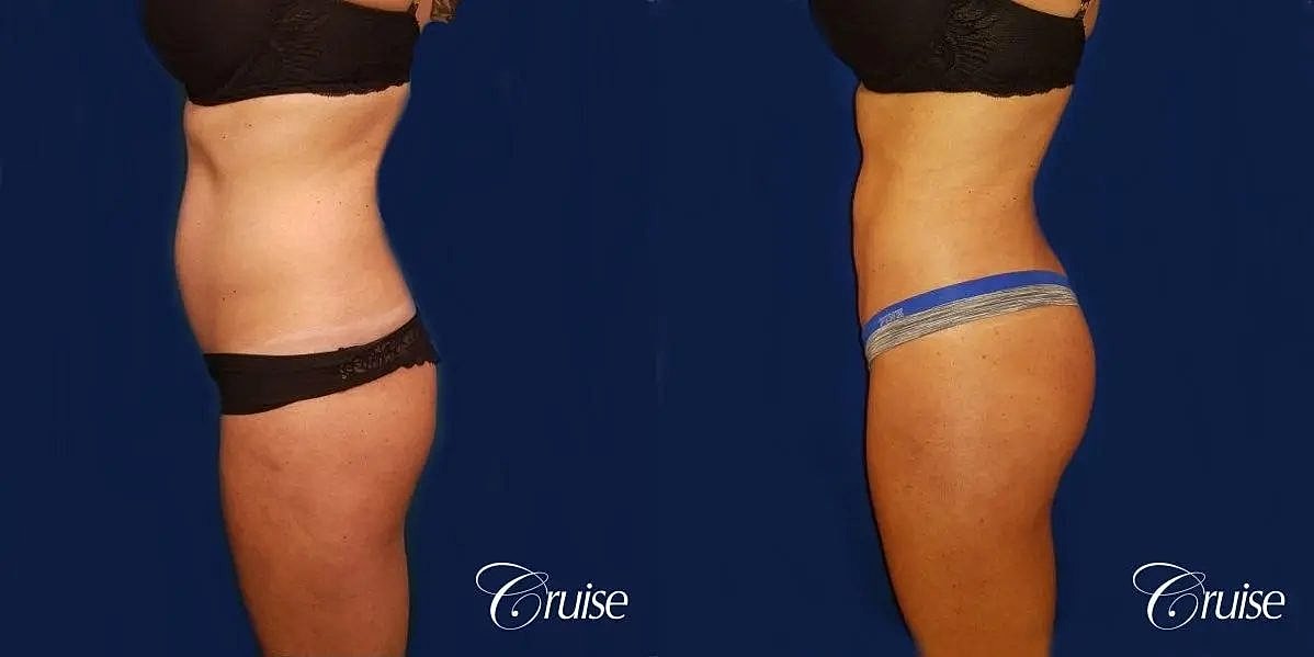 Liposuction Before & After