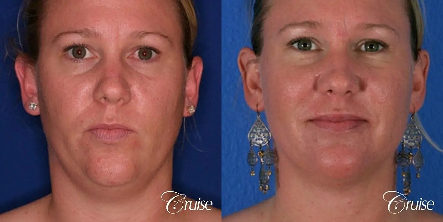 Liposuction Before & After