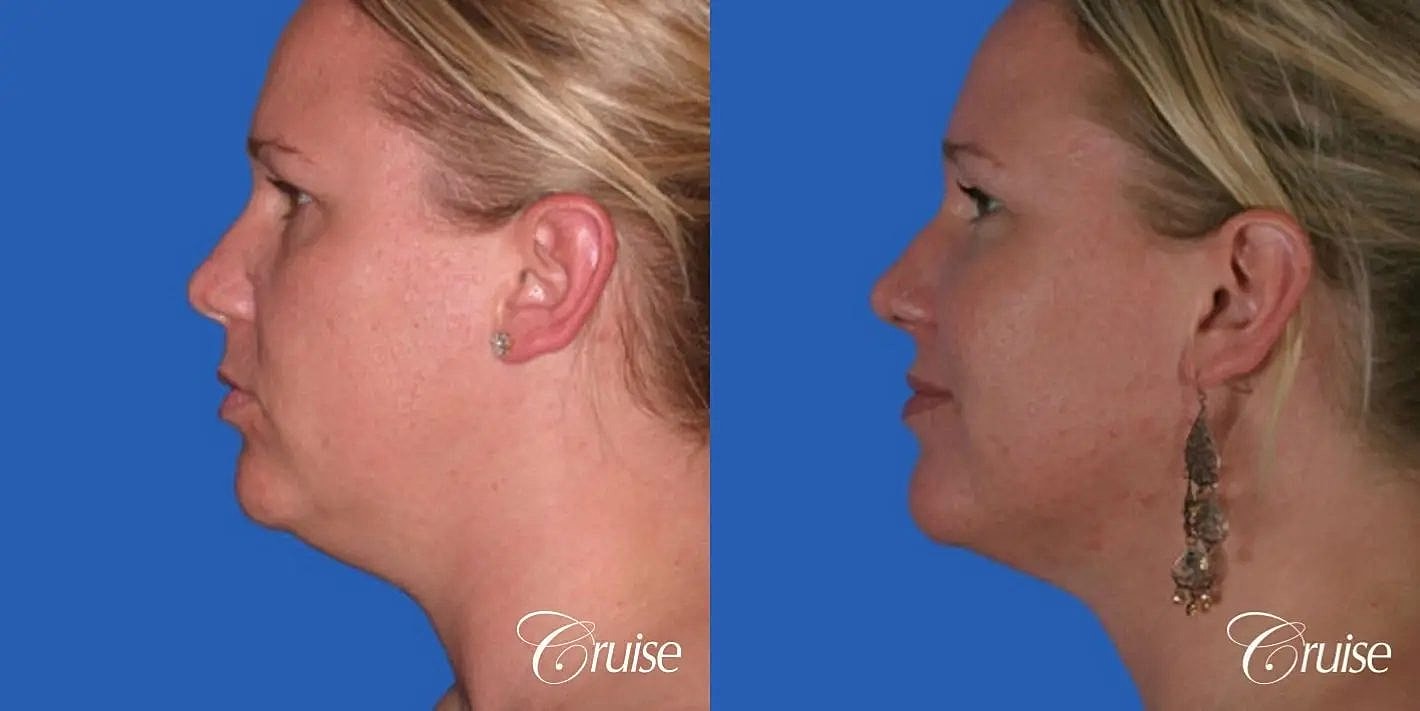 Liposuction Before & After
