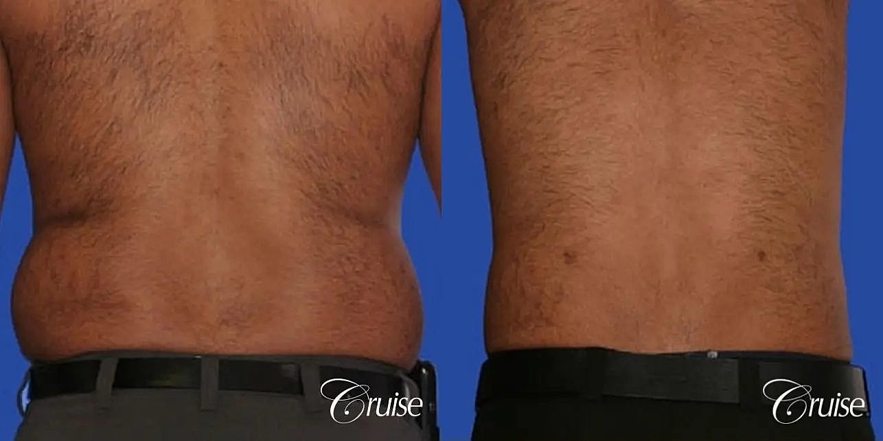 Liposuction Before & After