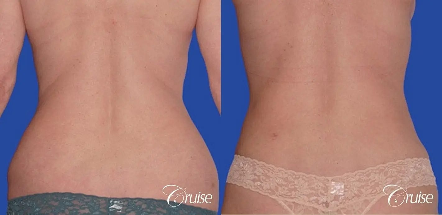 Liposuction Before & After