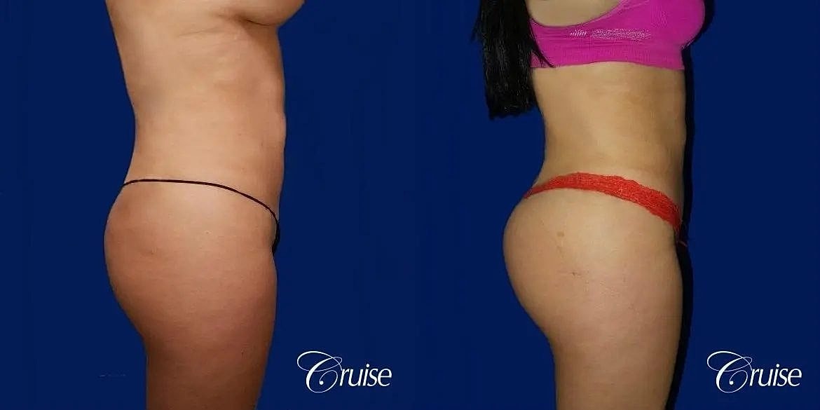 Liposuction Before & After