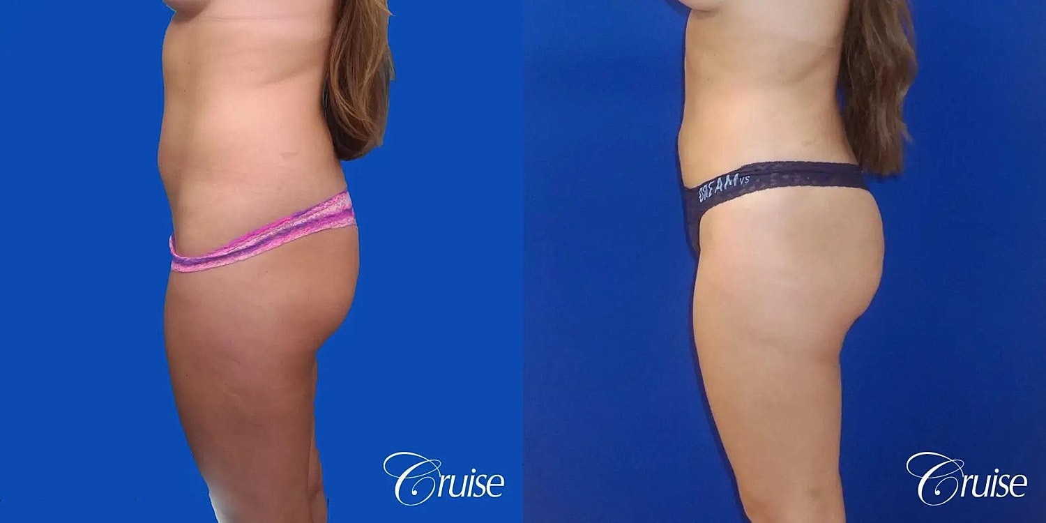 Liposuction Before & After