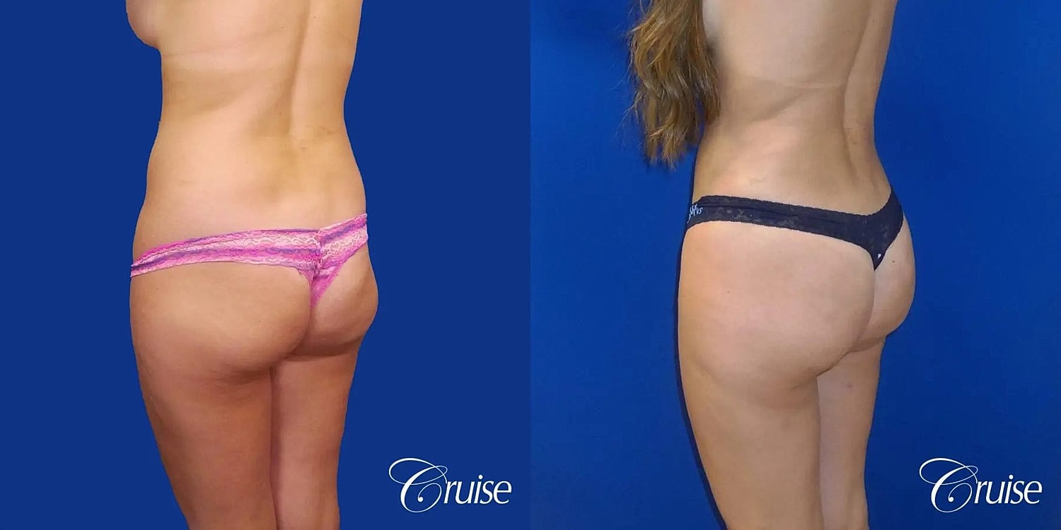 Liposuction Before & After