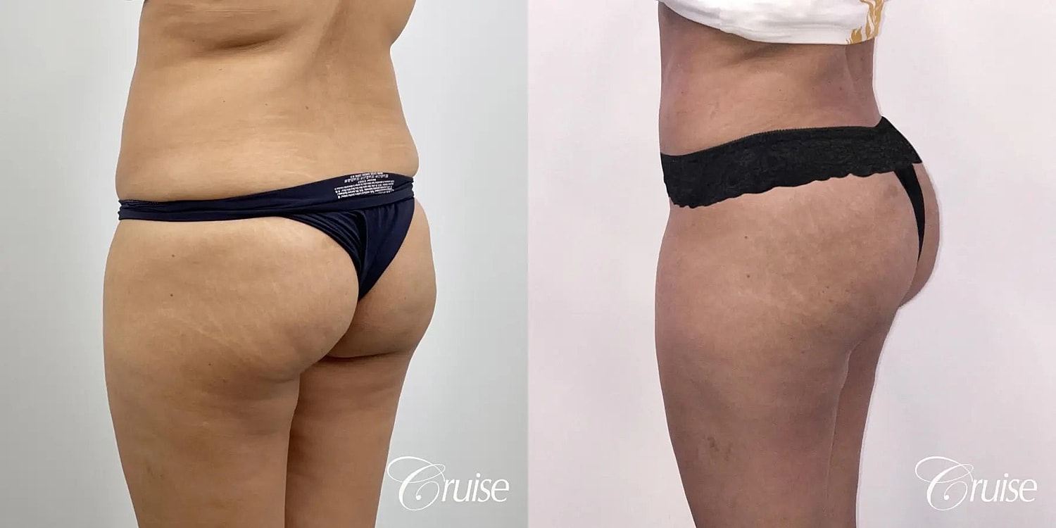 Liposuction Before & After