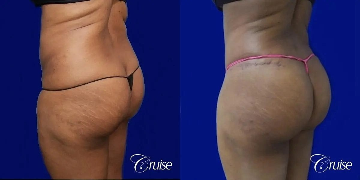 Liposuction Before & After