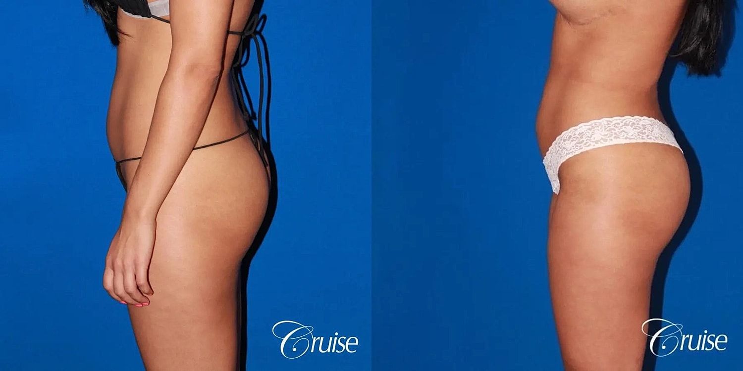 Liposuction Before & After