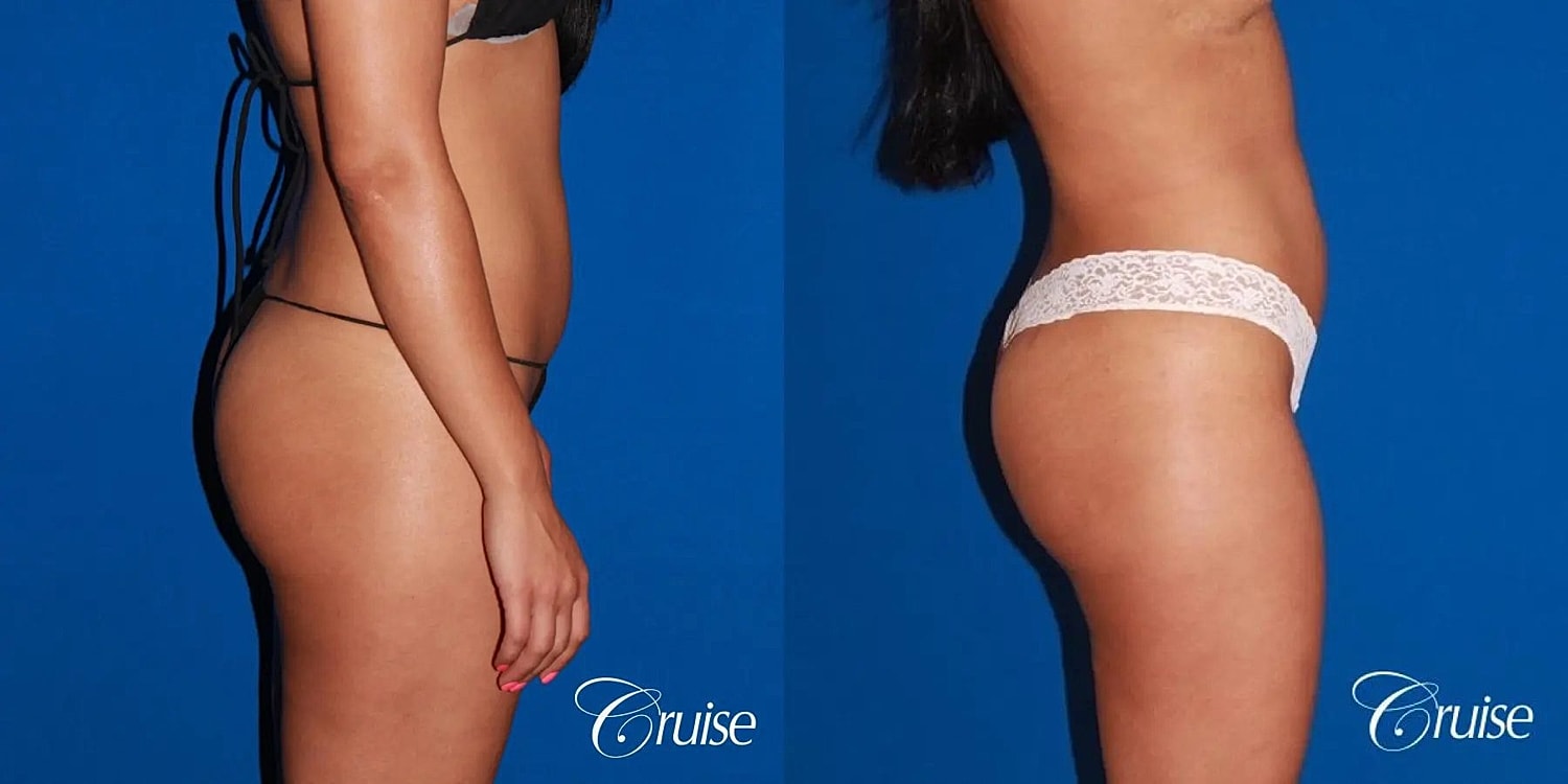 Liposuction Before & After