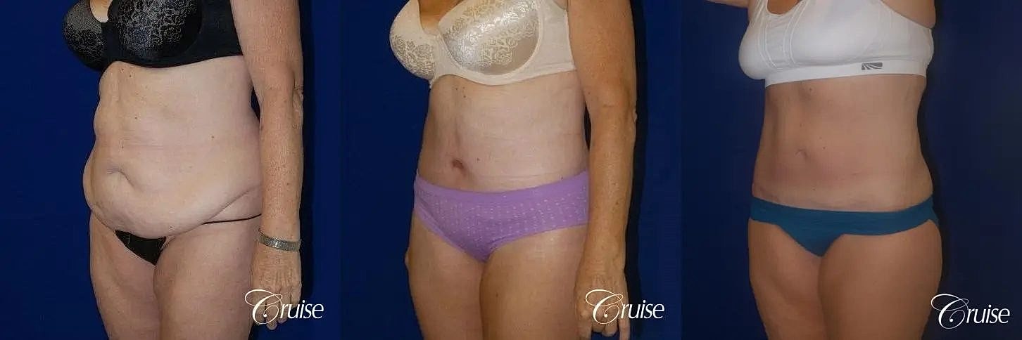 Liposuction Before & After