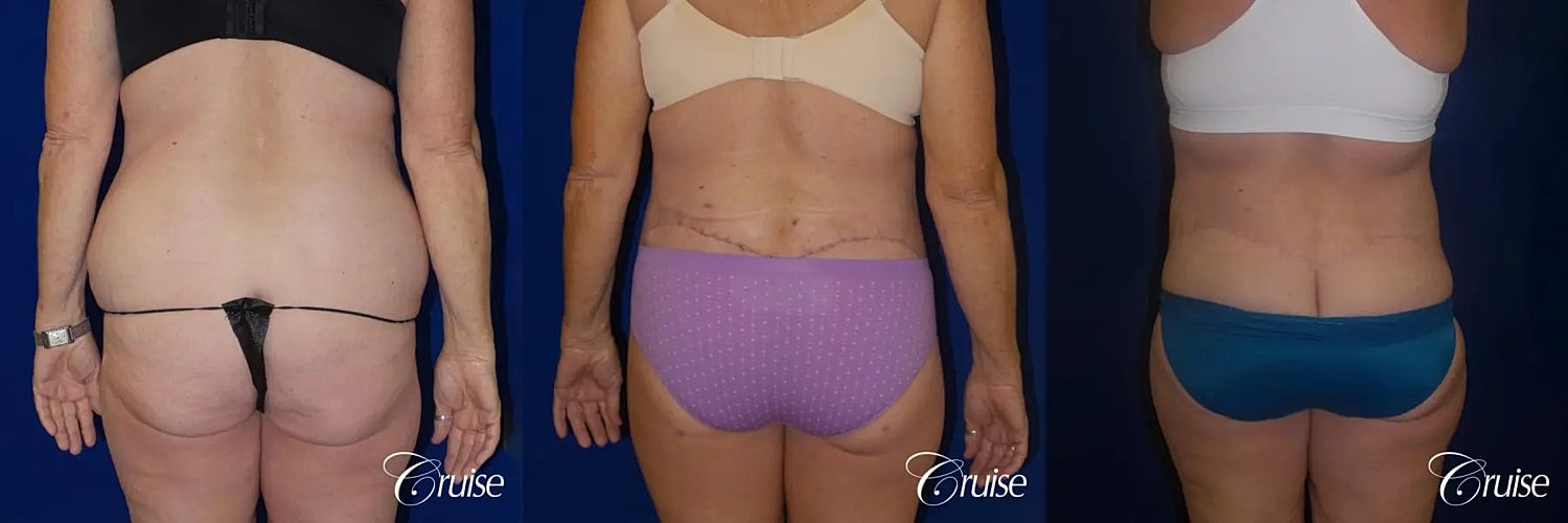 Liposuction Before & After