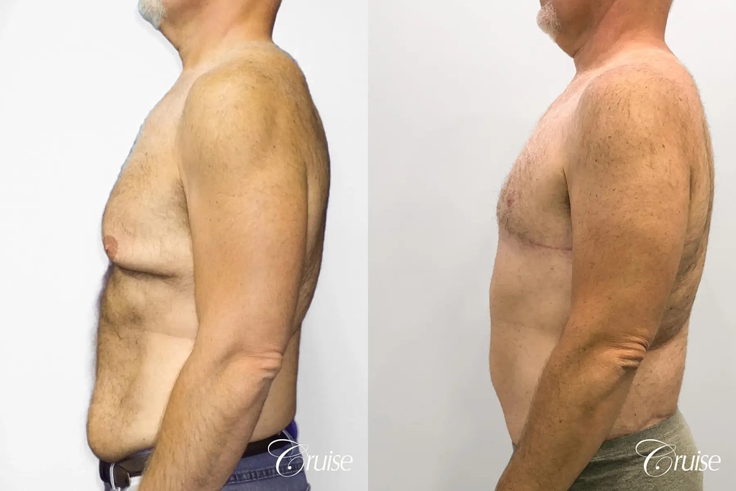 Gynecomastia Surgery Before & After