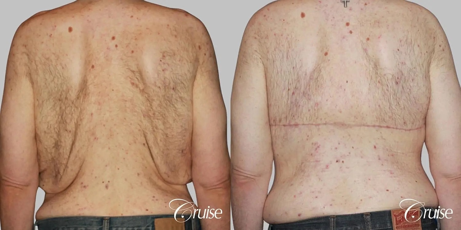 Gynecomastia Surgery Before & After