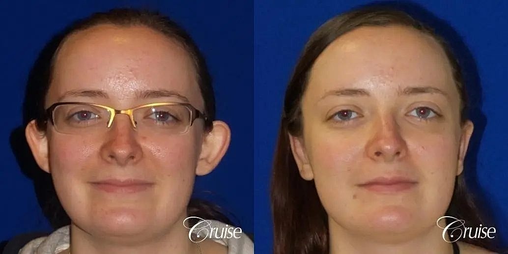 Otoplasty Earlobe Repair Before & After