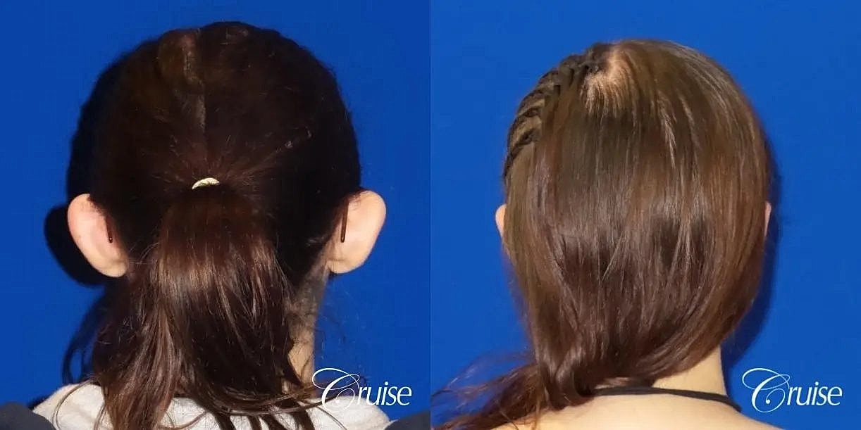 Otoplasty Earlobe Repair Before & After