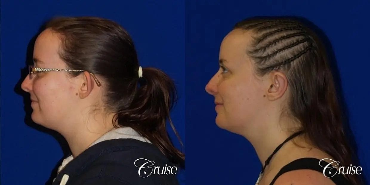 Otoplasty Earlobe Repair Before & After