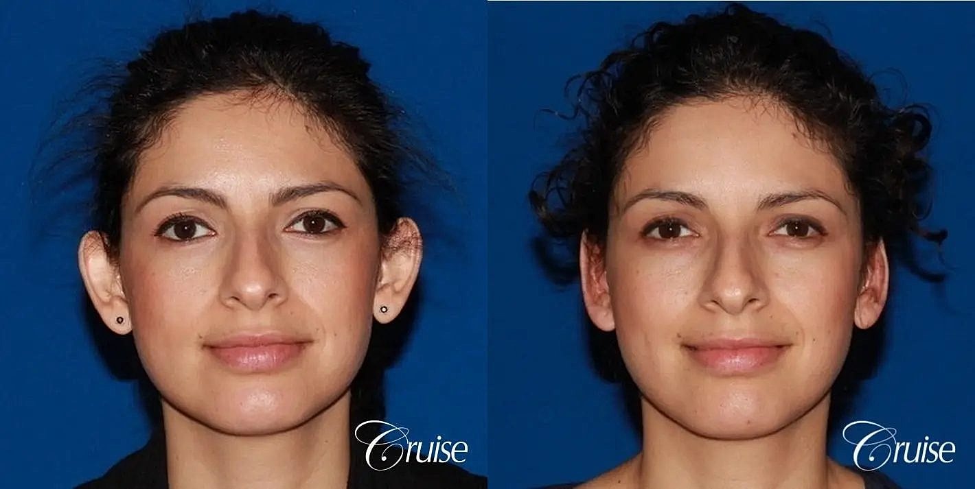 Otoplasty Earlobe Repair Before & After