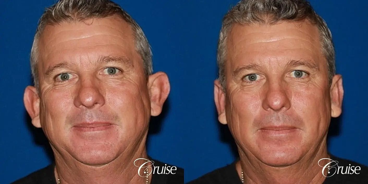 Otoplasty Earlobe Repair Before & After