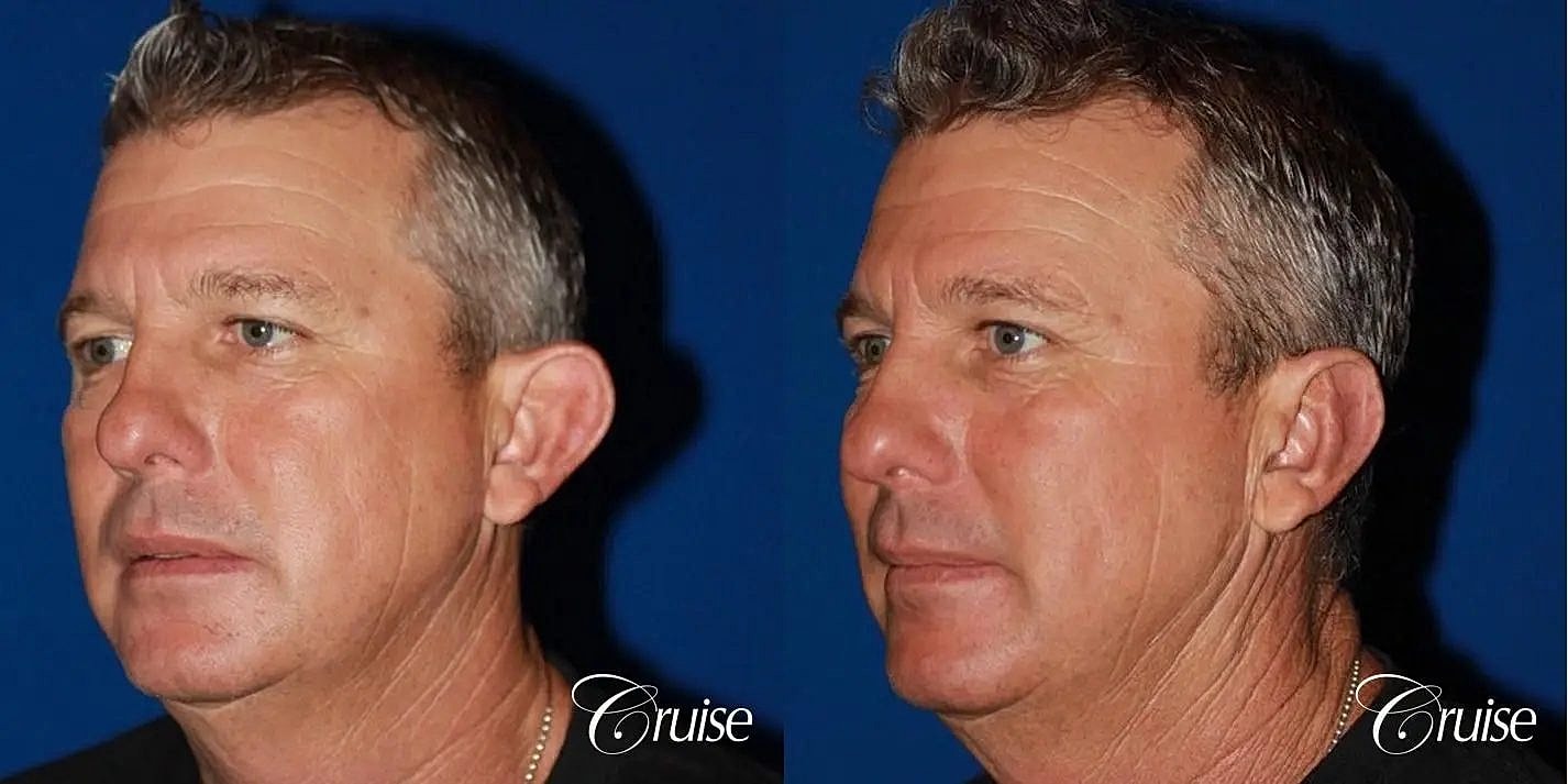 Otoplasty Earlobe Repair Before & After