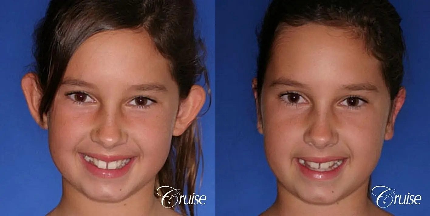 Otoplasty Earlobe Repair Before & After