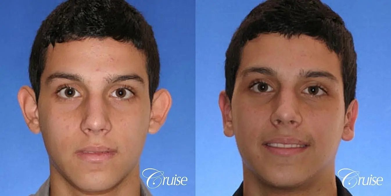 Otoplasty Earlobe Repair Before & After