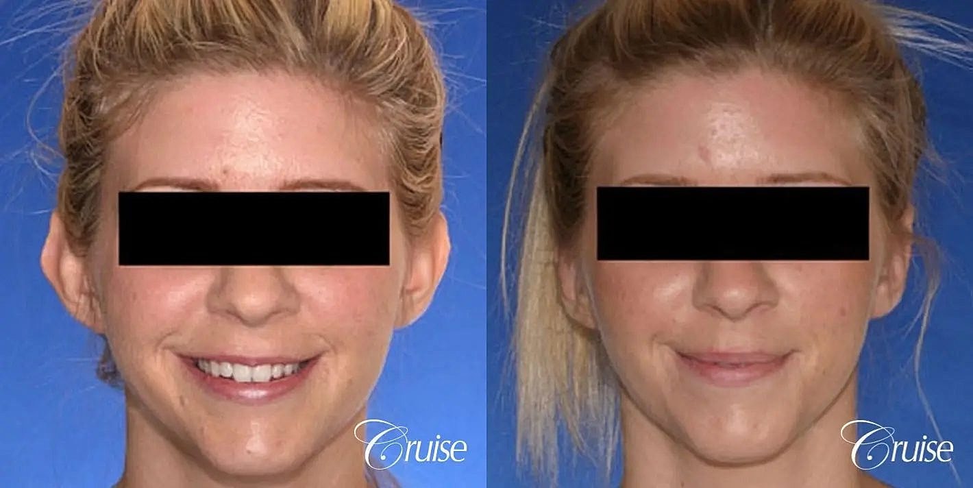 Otoplasty Earlobe Repair Before & After