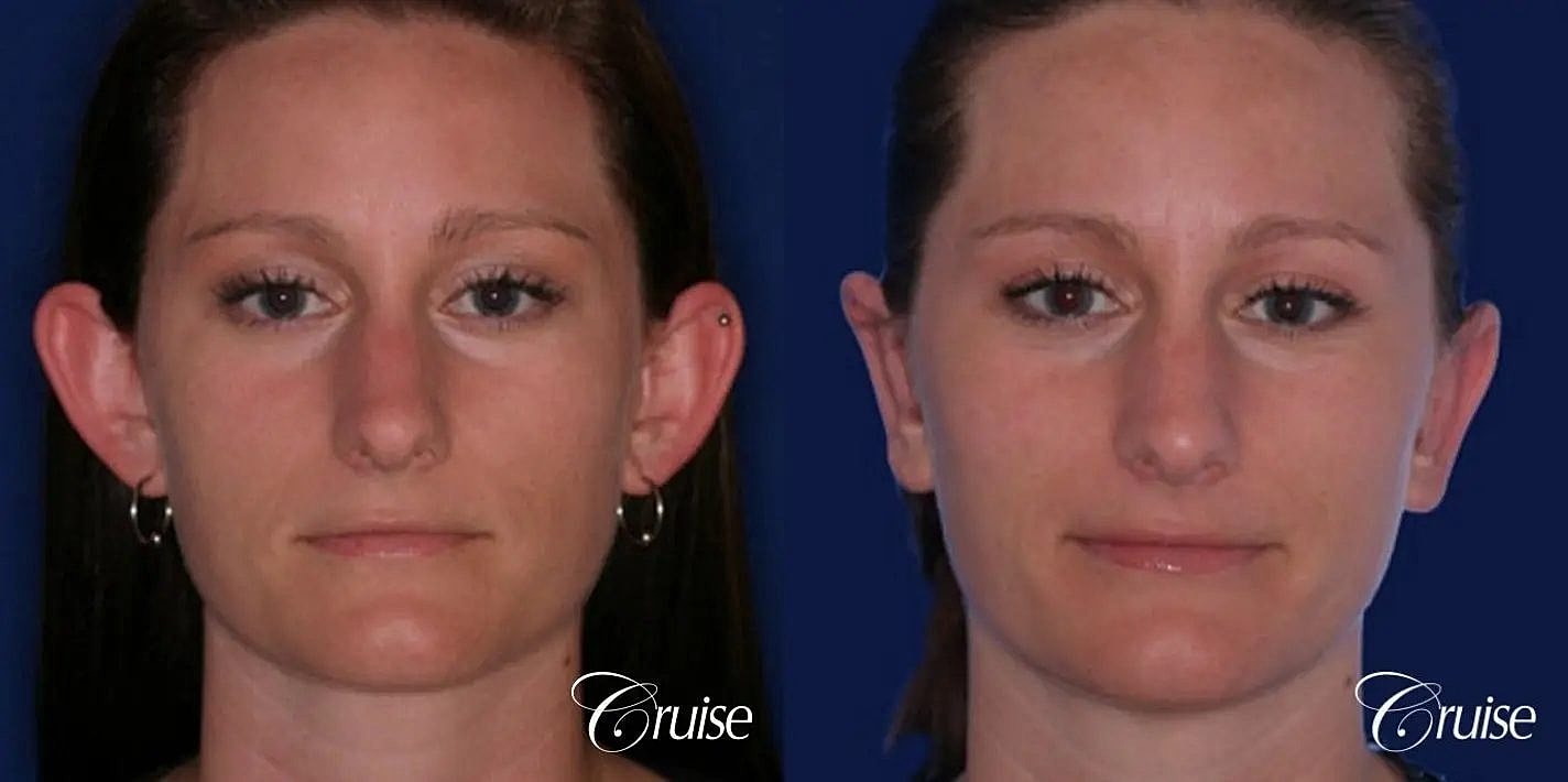 Otoplasty Earlobe Repair Before & After