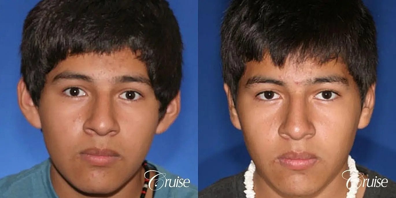 Otoplasty Earlobe Repair Before & After