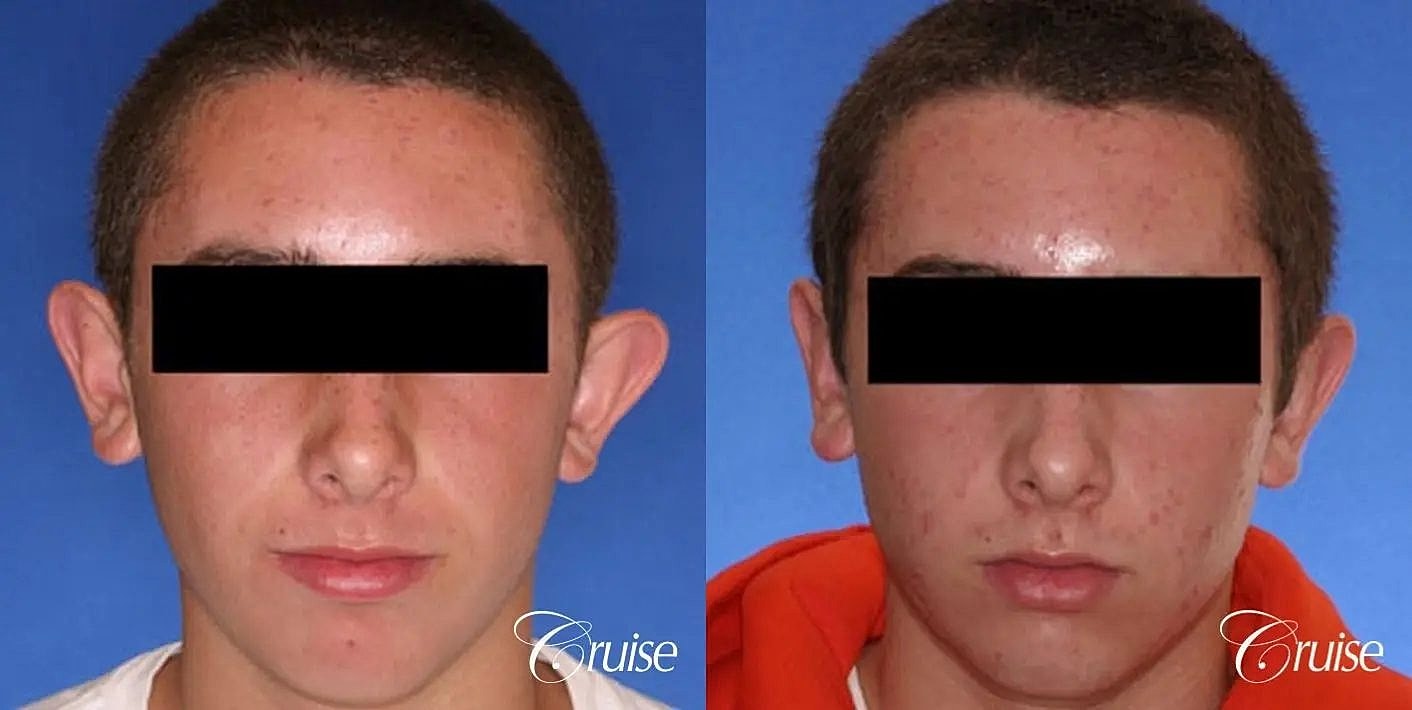 Otoplasty Earlobe Repair Before & After