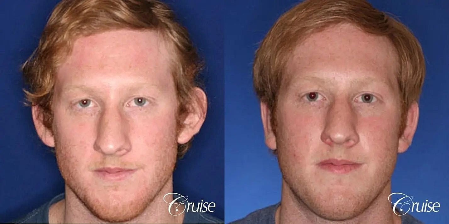 Otoplasty Earlobe Repair Before & After