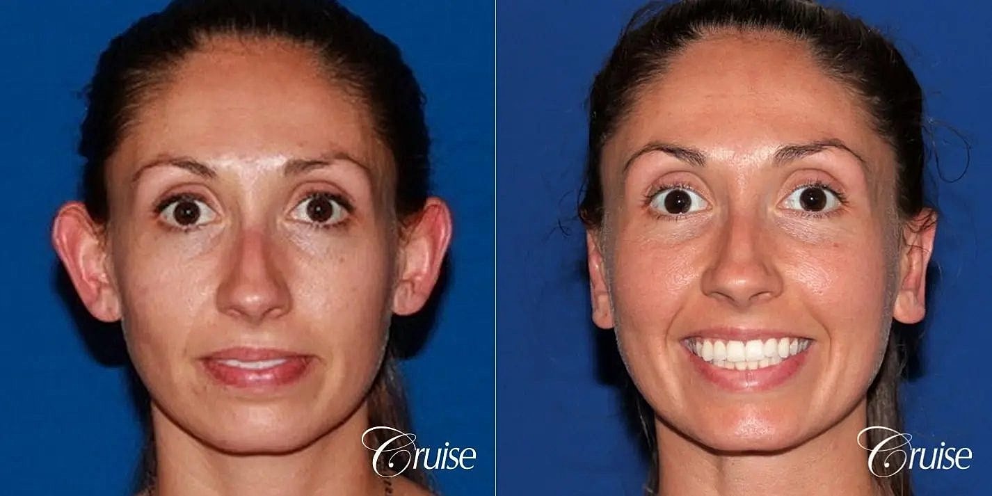 Otoplasty Earlobe Repair Before & After
