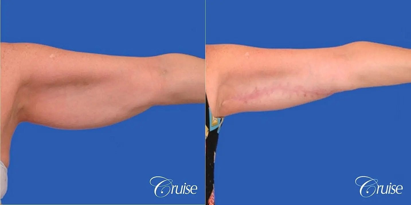 Arm Lift Before & After