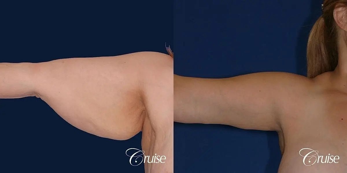 Arm Lift Before & After