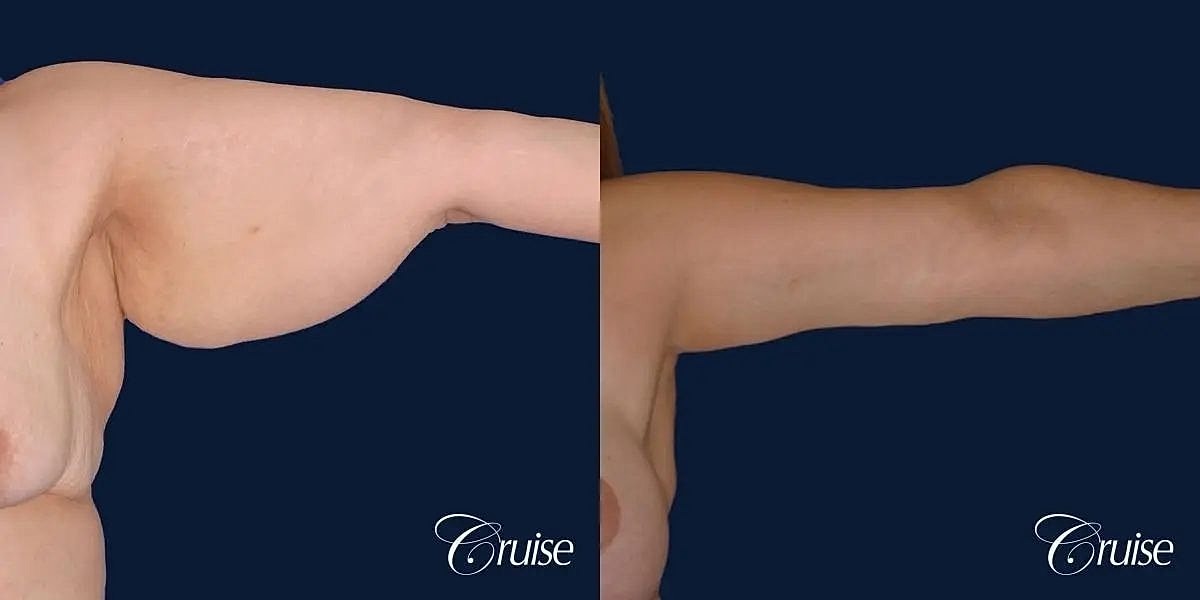 Arm Lift Before & After