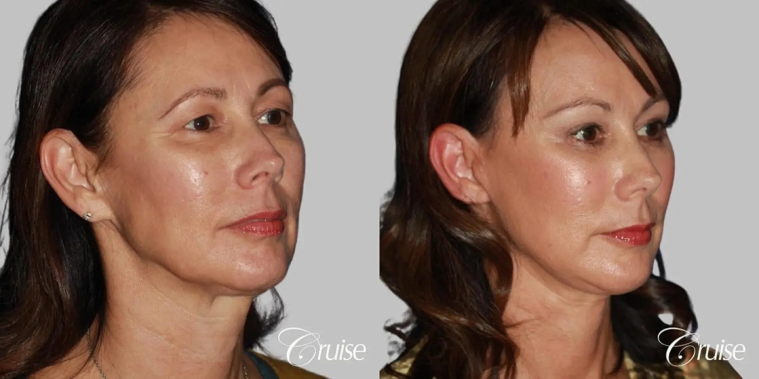 Blepharoplasty Before & After