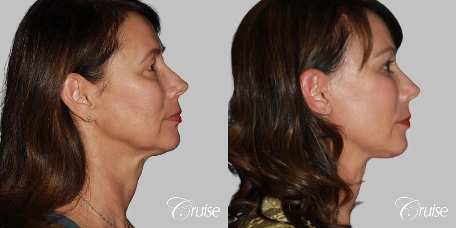 Blepharoplasty Before & After