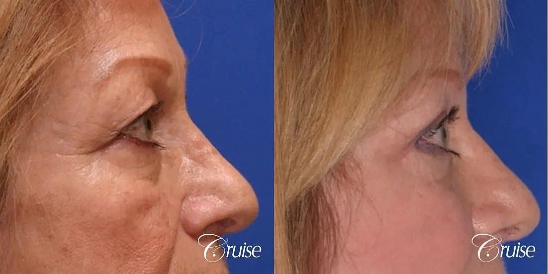 Blepharoplasty Before & After