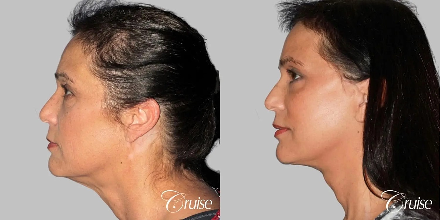 Blepharoplasty Before & After