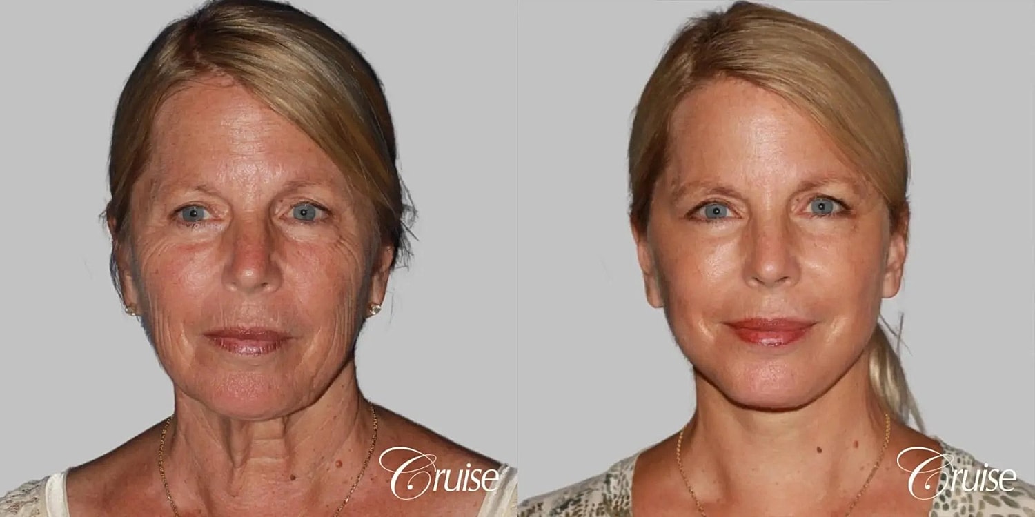 Face Lift Before & After