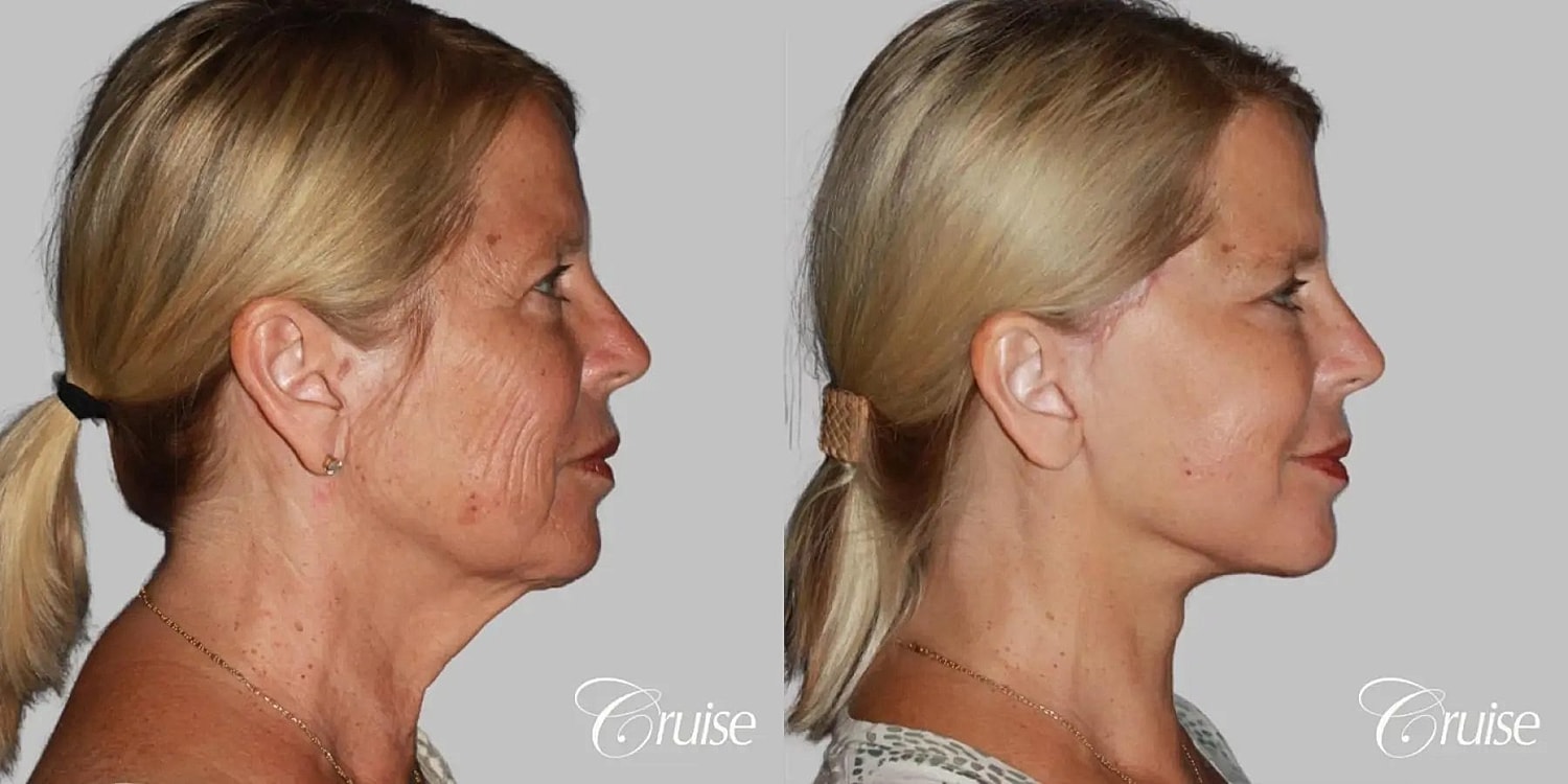 Face Lift Before & After
