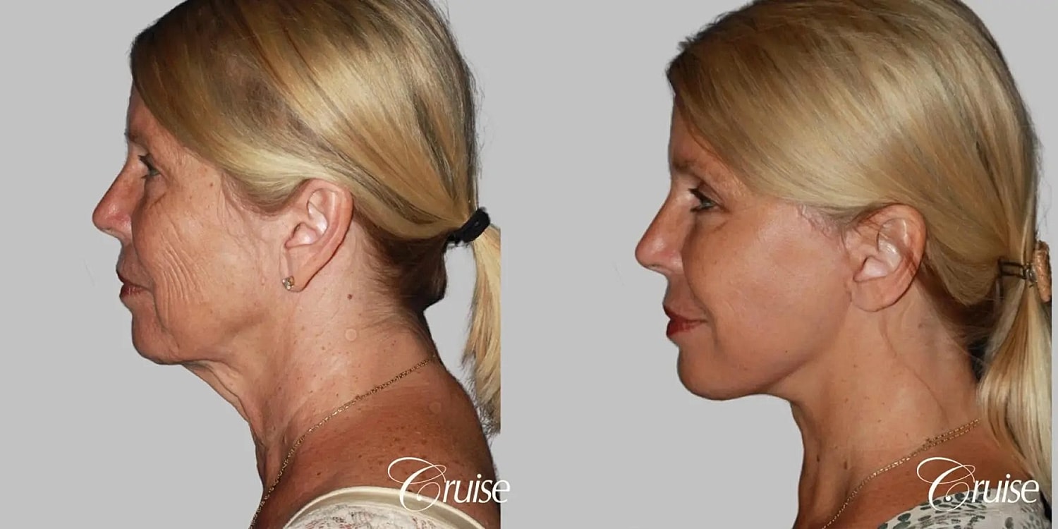 Face Lift Before & After
