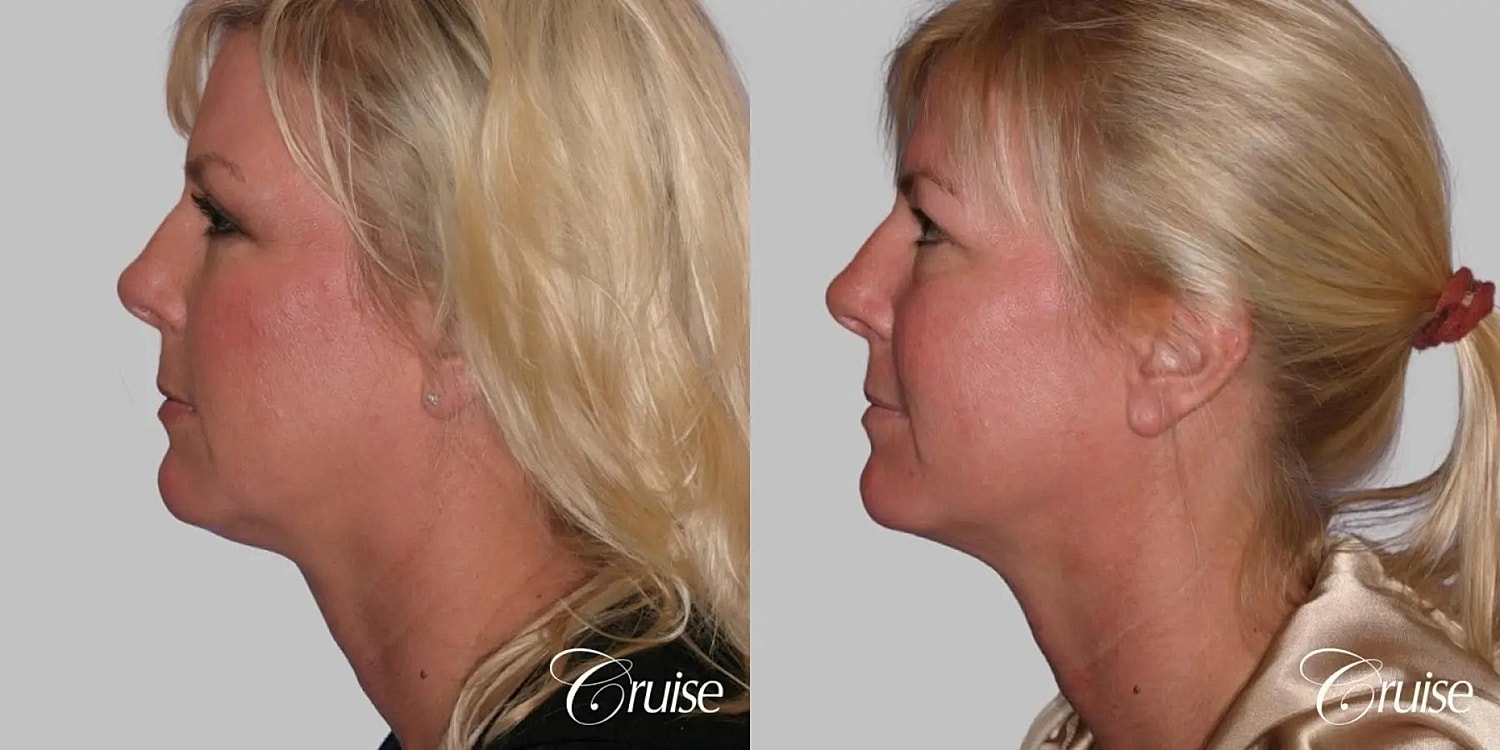 Face Lift Before & After