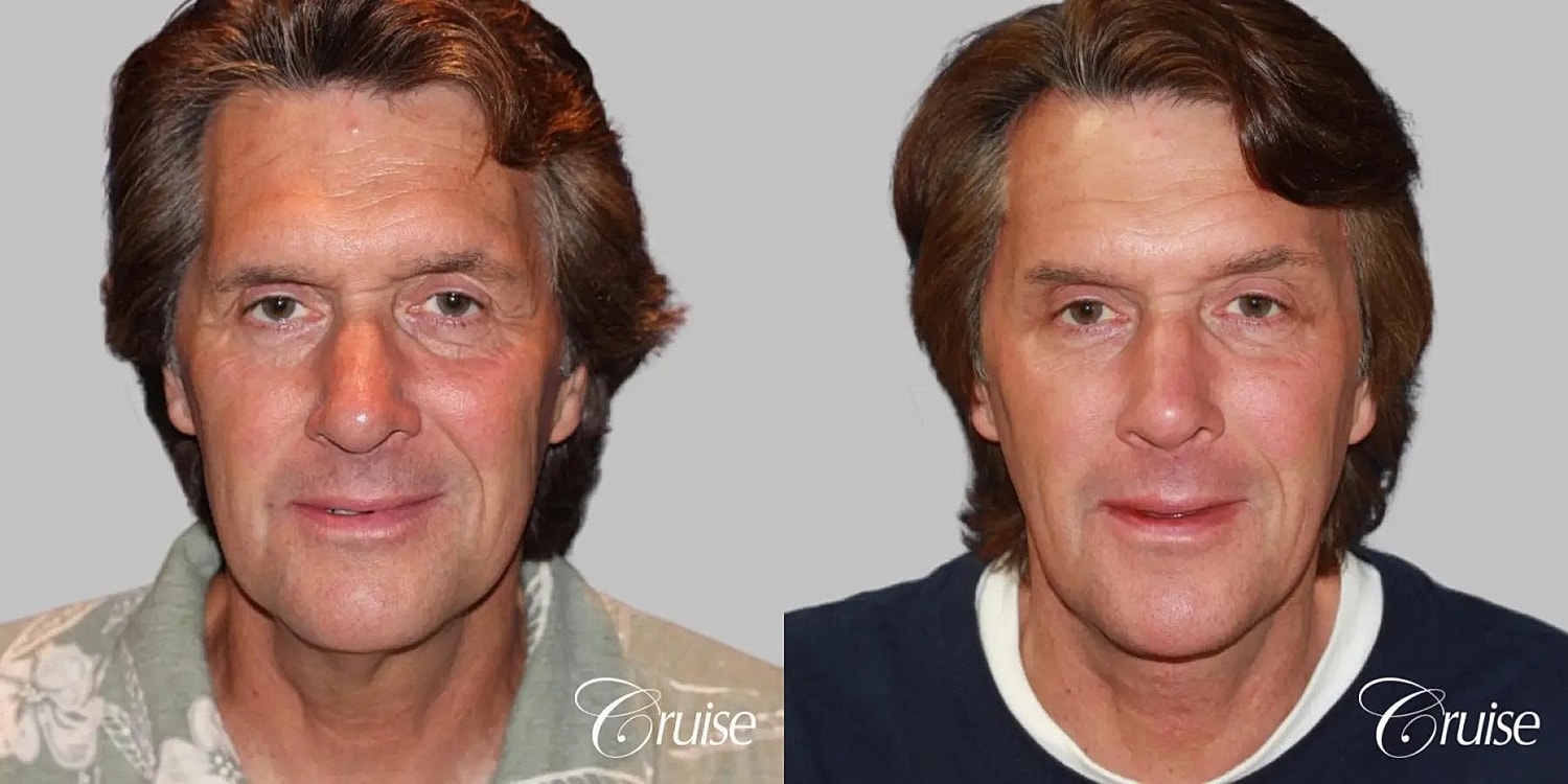 Face Lift Before & After