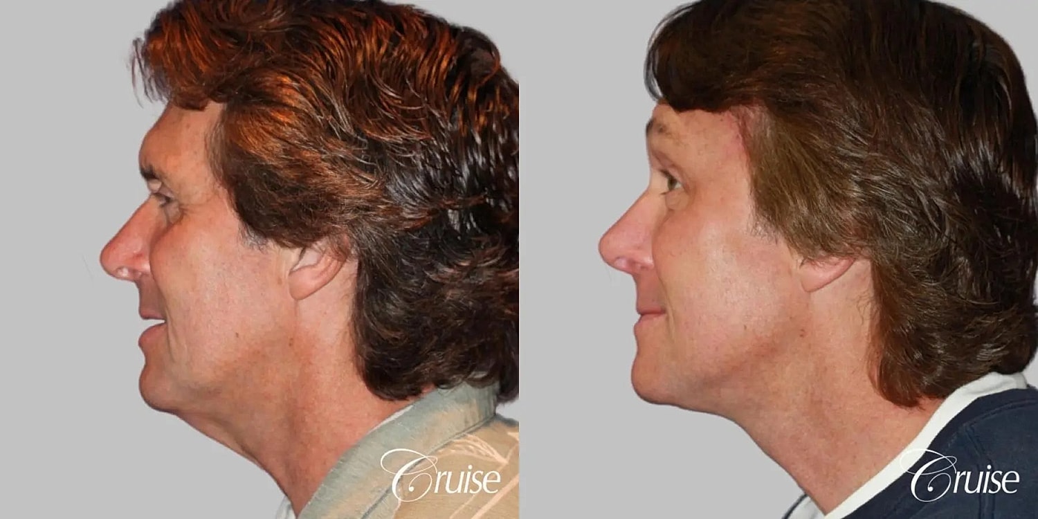 Face Lift Before & After