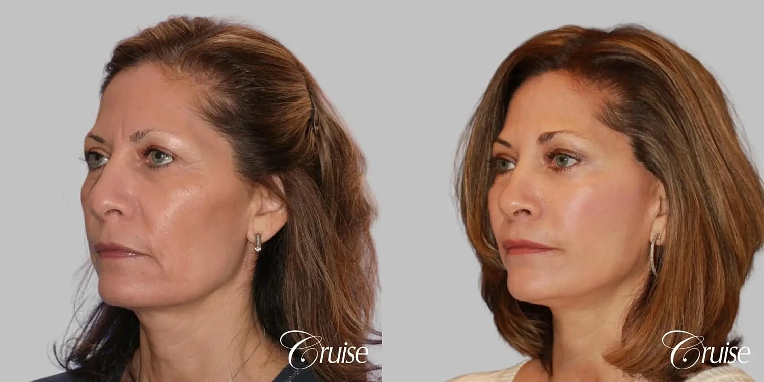 Face Lift Before & After