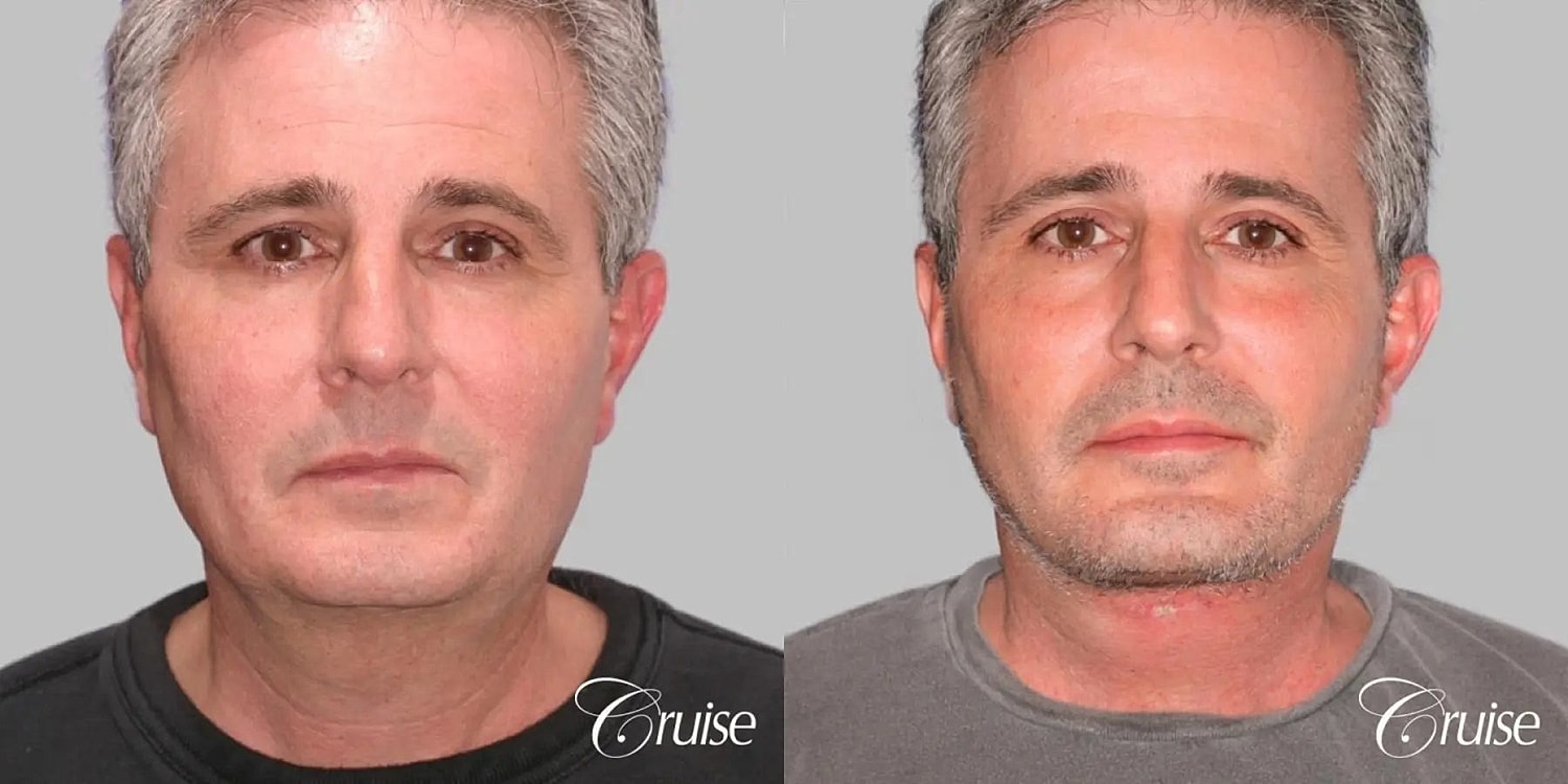 Face Lift Before & After