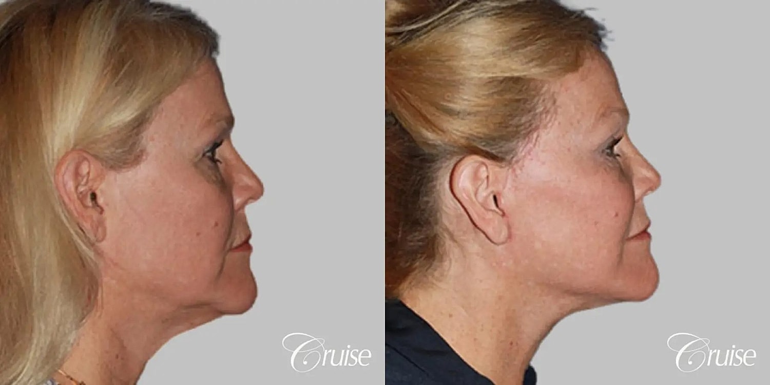 Face Lift Before & After