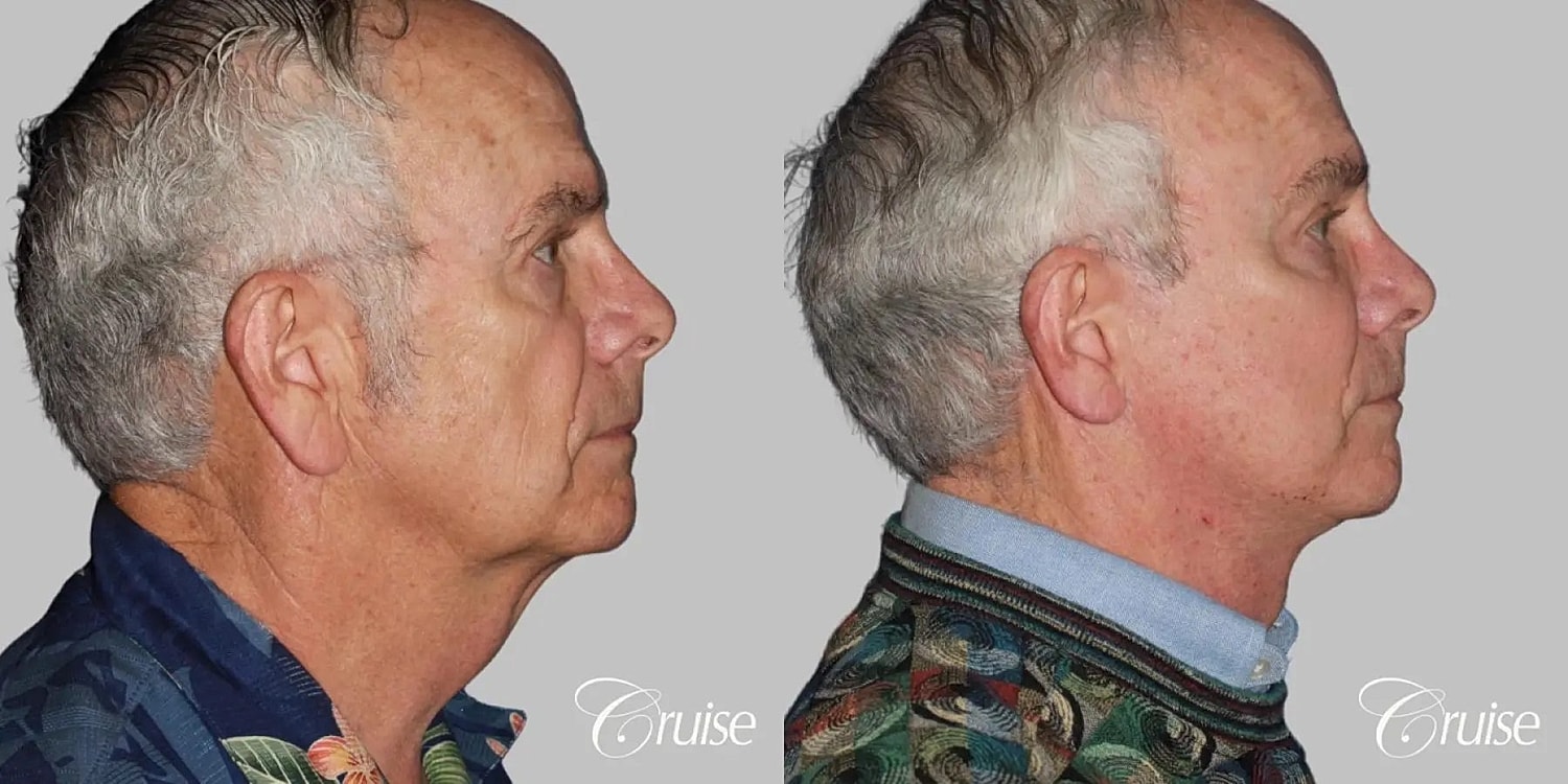 Face Lift Before & After