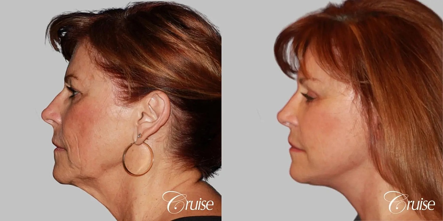 Face Lift Before & After